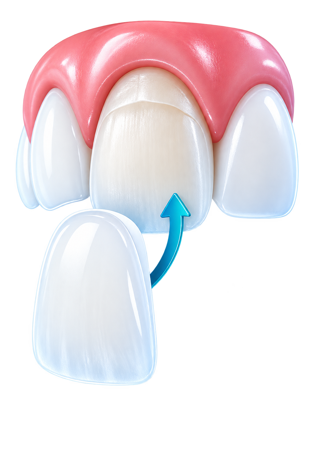 veneers